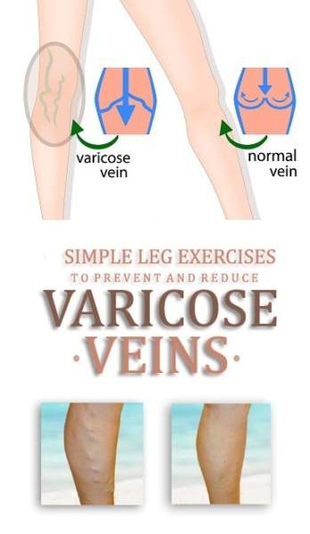 Geriausi pratimai varikozinėms venoms