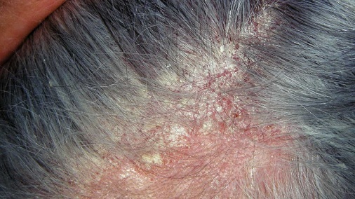 Seboreik Dermatit