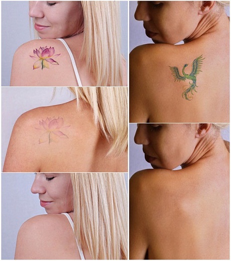 tatuiruotės pašalinimas