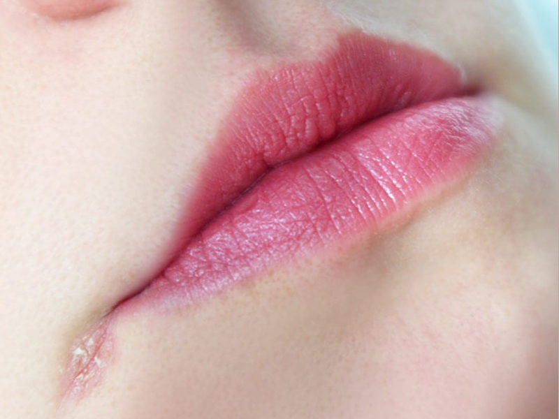 Natūralios lūpų kampučių procedūros