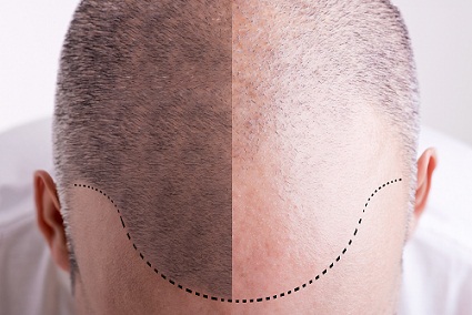 plaukų persodinimas-indoras