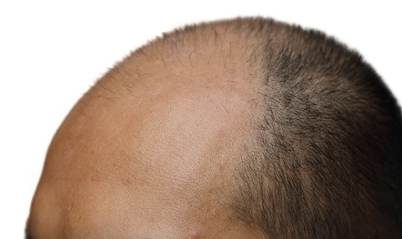 best-hair-transplant-in-jaipur