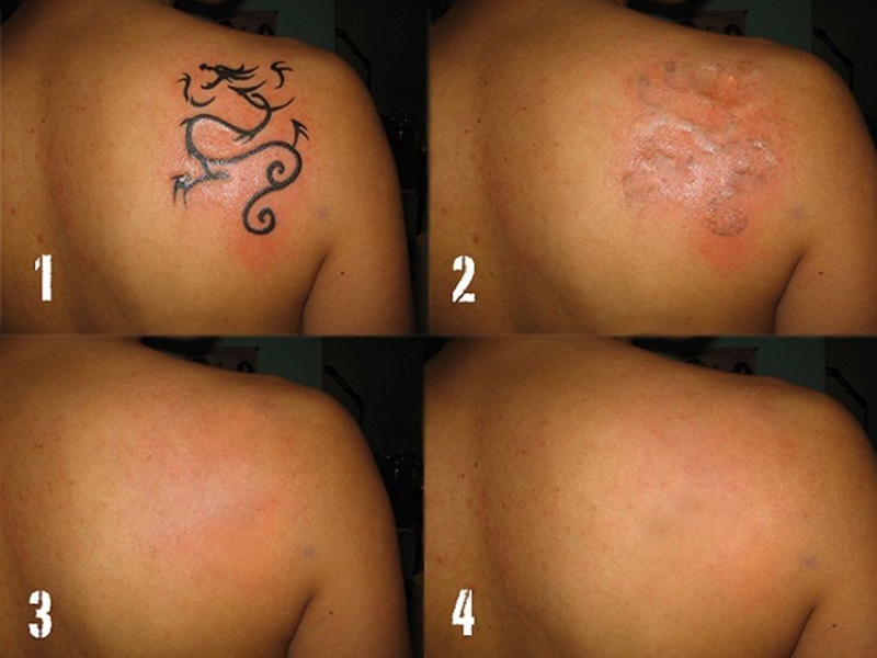 Tatuiruočių šalinimo lazeriu procedūros