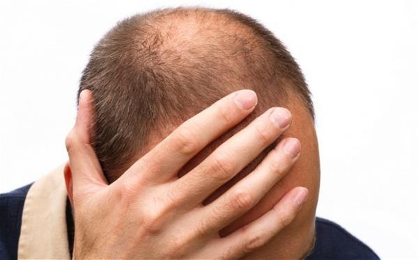 Μεταμόσχευση μαλλιών φαλάκρα ανδρών