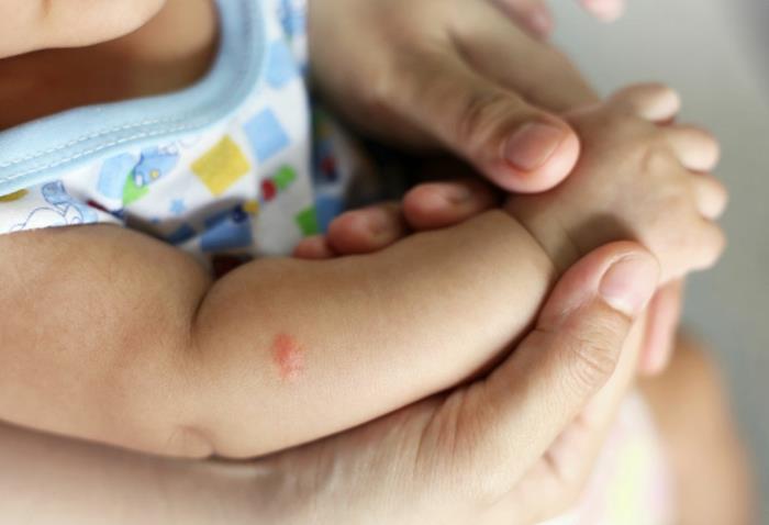 Τα σπιτικά φάρμακα για τα τσιμπήματα κουνουπιών αντιμετωπίζουν τα παιδιά
