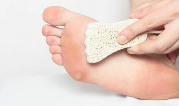 Απαλλαγείτε από τα καλαμπόκια Φροντίδα των ποδιών Αφαιρέστε το δέρμα του κερατοειδούς Biemsstein