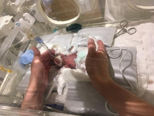 Το μικρότερο μωρό στον κόσμο, το οποίο ζύγιζε μόλις 268 γραμμάρια κατά τη γέννηση, πηγαίνει σπίτι μικροσκοπικά στη μονάδα εντατικής θεραπείας κατά τη γέννηση