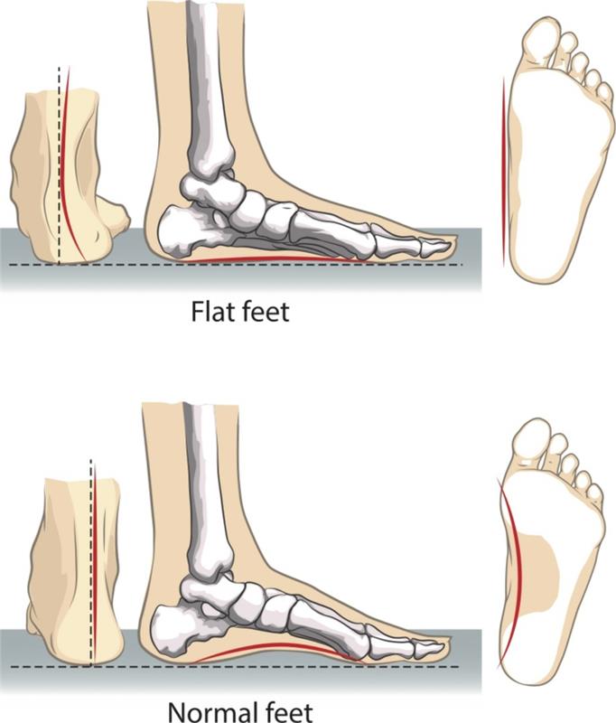 Ασκήσεις επίπεδων ποδιών διόρθωση θεραπείας επίπεδων ποδιών