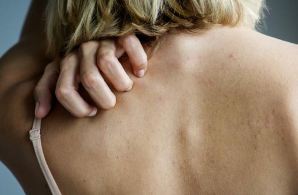 Τι βοηθάει στον κνησμό του κνησμού του δέρματος στο σώμα πίσω