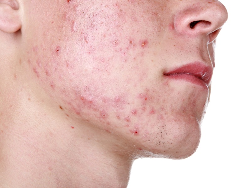 Akne Rosacea Nedenleri, Türleri, Belirtileri, Çözümleri ve Önleme İpuçları