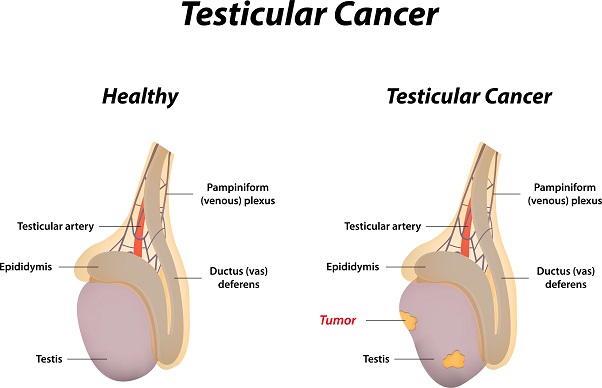 Testis Kanseri Belirtileri