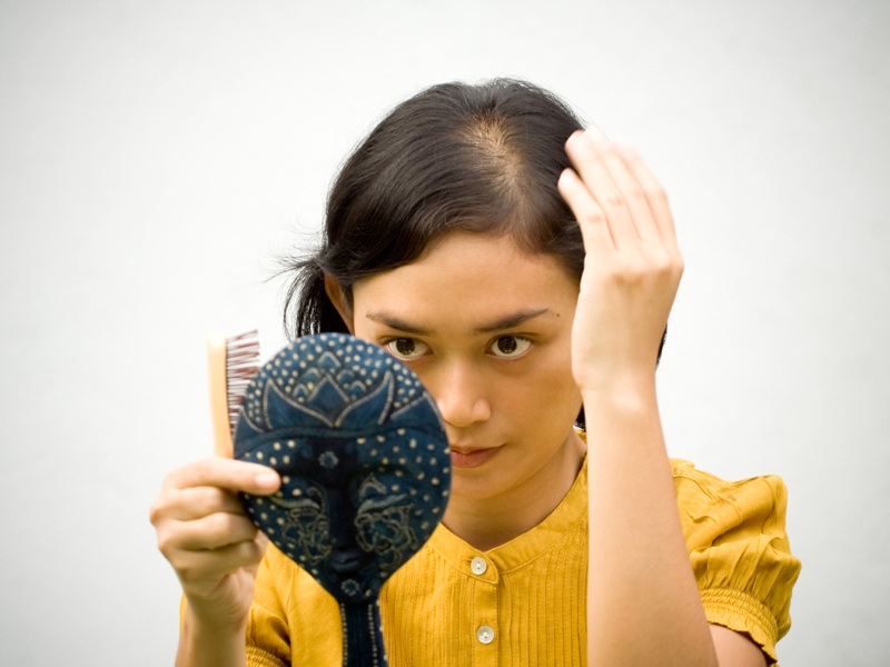 Alopecijos srities gydymas