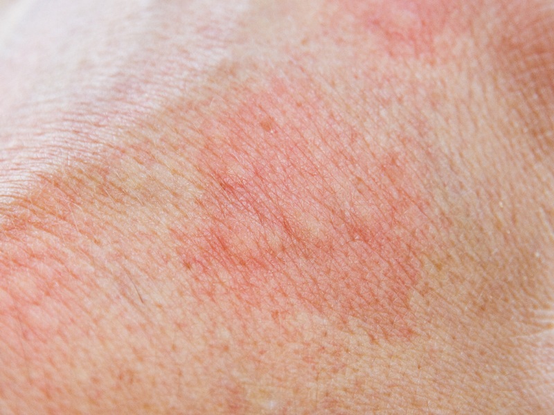 Nedelsdami atsikratykite odos alergijos