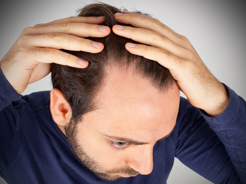 Hormonal Dengesizlik Nedeniyle Saç Dökülmesi