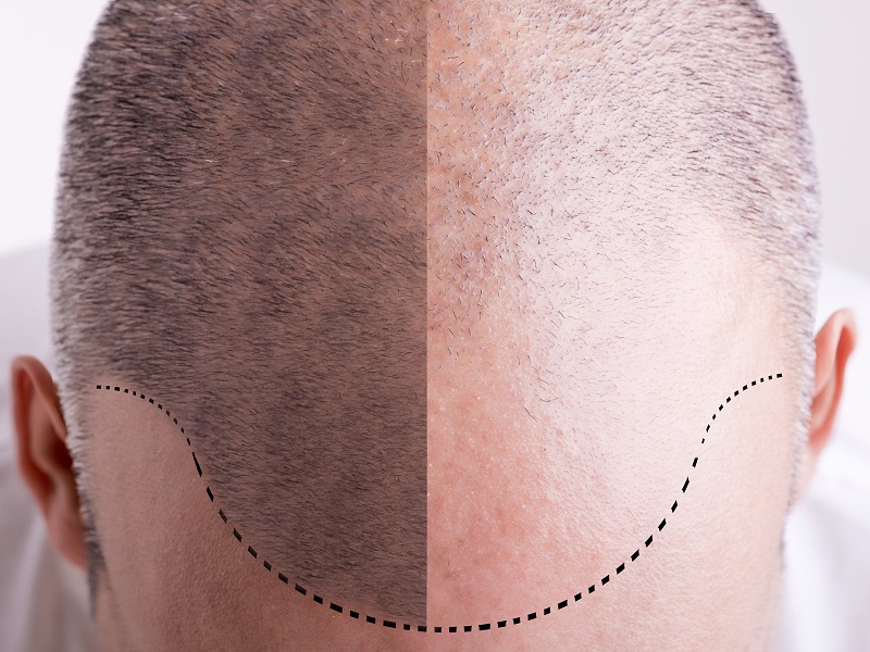 Plaukų persodinimo šalutinis poveikis