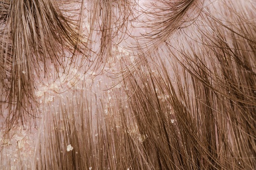 plaukų priežiūros procedūros pleiskanotiems plaukams