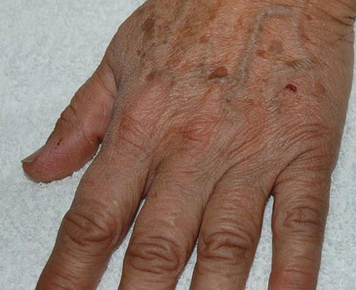 Ellerdeki Kırışıklıkları Gidermek İçin Kimyasal Peeling
