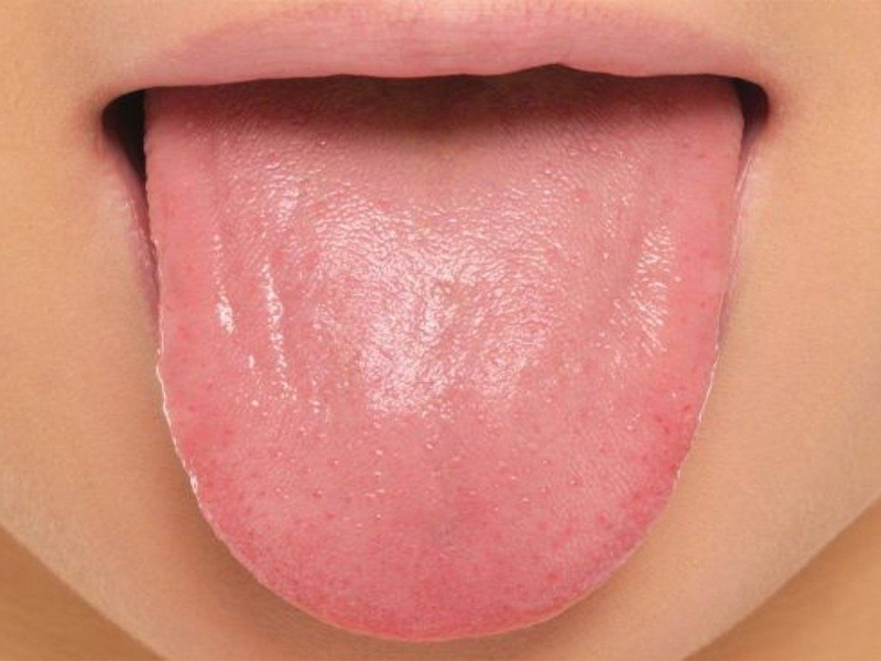 Kaip gydyti spuogus ant liežuvio