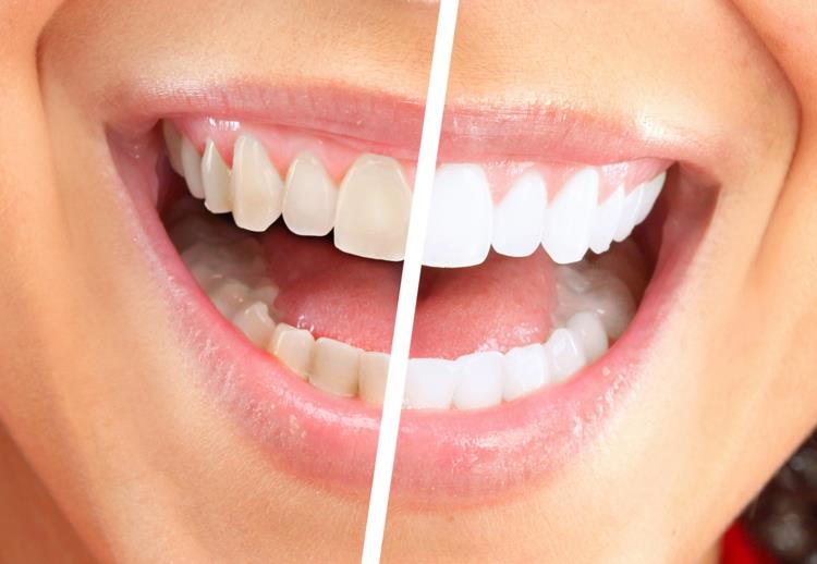 η επίδραση του λαδιού καρύδας είναι λάδι καρύδας υγιή λευκά δόντια πριν από μετά