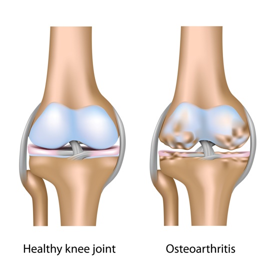 osteoporozun nedenleri-ve-semptomları