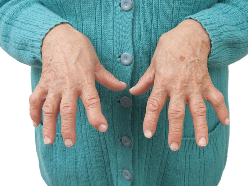 Reumatoidinio artrito simptomai ir priežastys