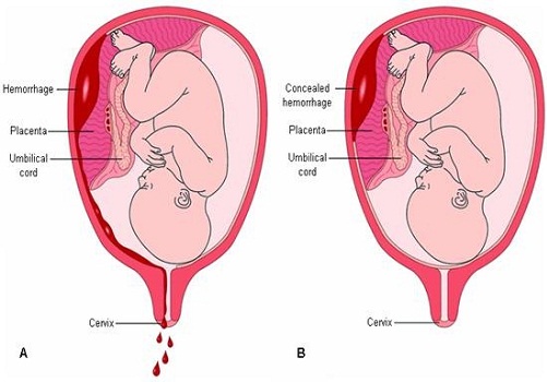 Hamilelikte Lekelenme 6