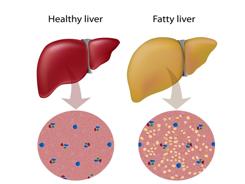 Yağlı Karaciğer Nedenleri ve Belirtileri