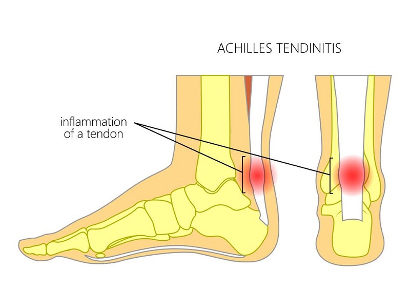 Aşil Tendon Ağrısı için ev ilaçları