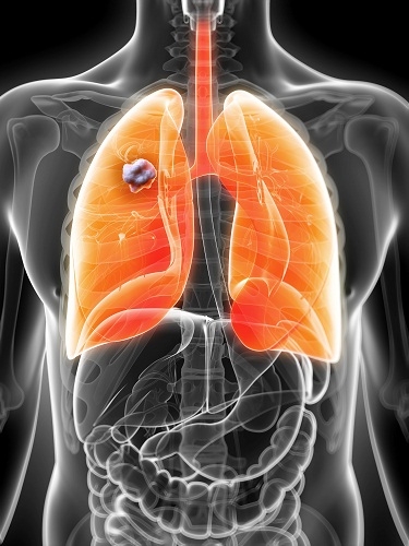 Akciğer kanseri