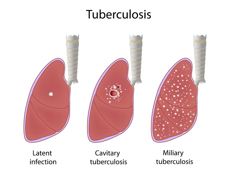 Tuberkuliozės simptomai ir priežastys