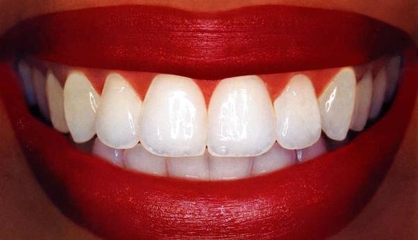 Τα πιο λευκά δόντια λαμβάνουν οδοντιατρική φροντίδα