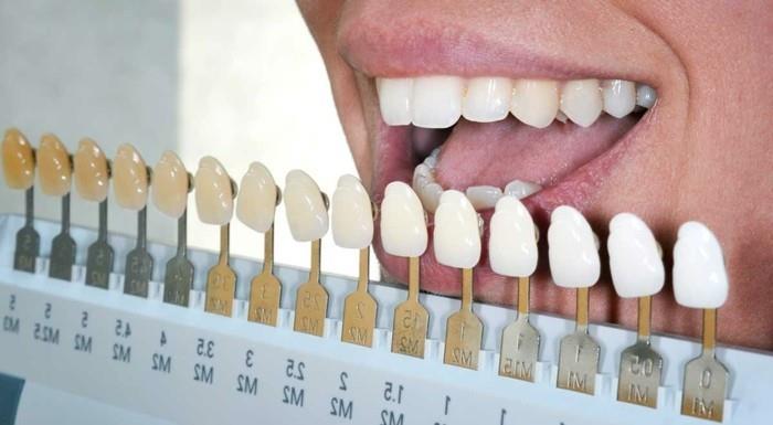 ιδέες λεύκανσης δοντιών λευκές μέθοδοι λεύκανσης δοντιών φωτεινότητα κλίμακας φωτεινότητας