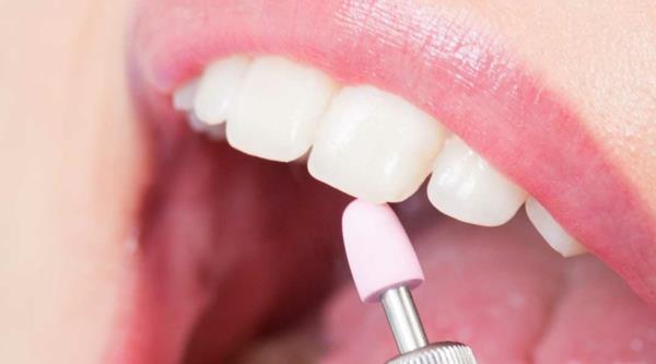 στίλβωση δοντιών οδοντική προφύλαξη